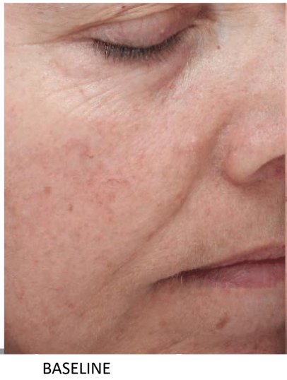 ALASTIN Restorative Skin Complex