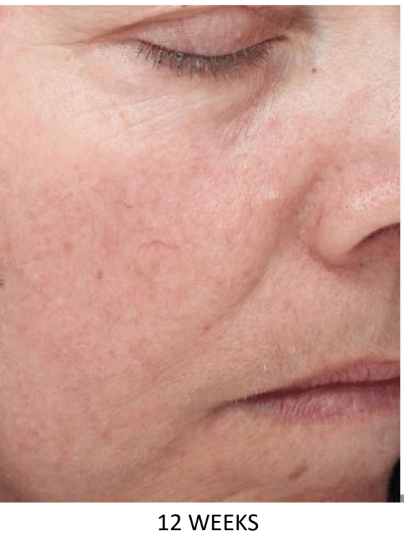 ALASTIN Restorative Skin Complex
