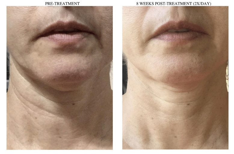 ALASTIN Restorative Neck Complex