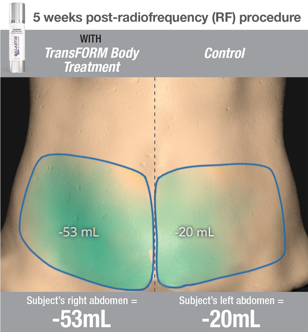 Female, age 54 – Subject photo courtesy of Amir Moradi, MD Treatment & Regimen: Subject received six radiofrequency procedures on both sides of the lower abdomen/flanks & followed-up treatment with a split abdomen regimen that included applying TransFORM Body Treatment 2X a day on the subject’s right side and no topical treatment on the subject’s left side (only the procedure). Individual results may vary.